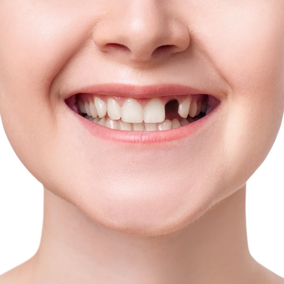 Dr Laroche - Implantologie